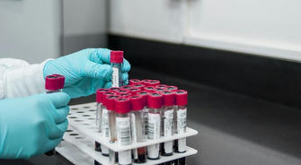 Blood tests help diagnose Alzheimer's disease with an accuracy rate of up to 90%