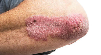 What You Must Understand About Psoriasis